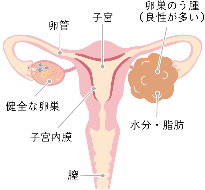 婦卵巣腫瘍（卵巣のう腫）